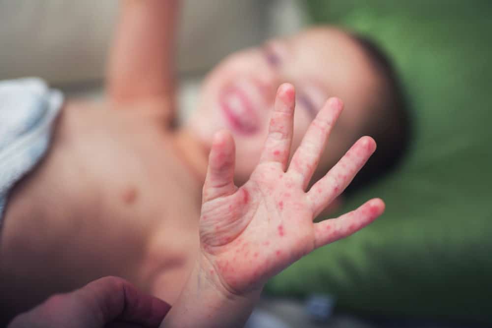 Hand-Mund-Fuß-Krankheit beim Kind